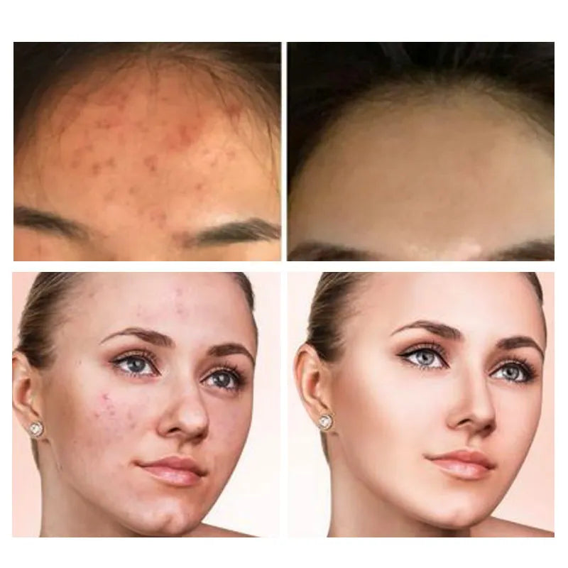 Solution Peeling AHA 30% + BHA 2%